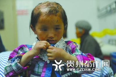 被燙傷的頭皮一直沒有愈合。