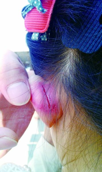 　　女童的耳朵被老師揪裂。圖片由女童家人提供
