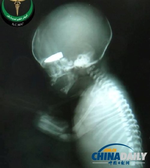 外媒曝?cái)④娔迷袐D當(dāng)游戲標(biāo)靶 射死胎兒獲香煙 外媒曝?cái)④娔迷袐D當(dāng)游戲標(biāo)靶 射死胎兒獲香煙