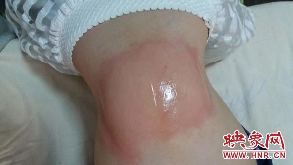 緯三路小學一名學生身上出現(xiàn)的不適癥狀