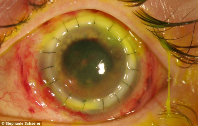 恐怖慎入！隱形眼鏡致英女子摘除眼球