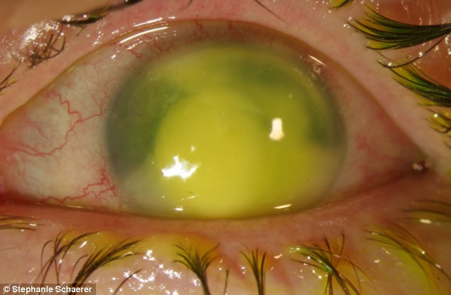 恐怖慎入！隱形眼鏡致英女子摘除眼球