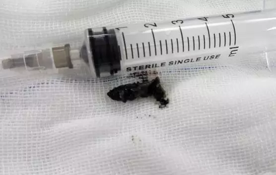 男童睡覺(jué)打鼾突然沒(méi)了呼吸 醫(yī)生從身上取出這東西