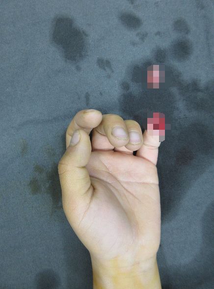 嚇哭！6歲男孩被夾斷手指 罪魁禍?zhǔn)拙故切７? oldsrc=