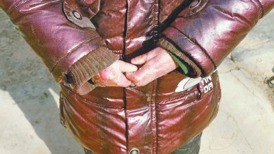 長(zhǎng)期受損的手指，已經(jīng)長(zhǎng)在了一起。