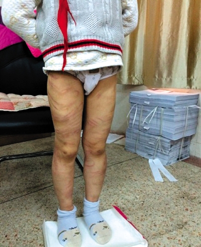 4月3日晚，微博網(wǎng)友“@朝廷半日閑”發(fā)圖文微博展示男童被虐待的慘狀。 微博截圖