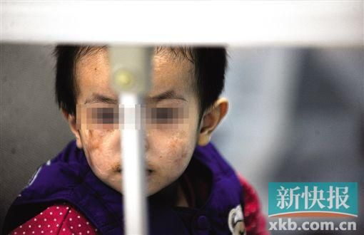 去年3月就能出院的小華(化名),目前還在廣州市婦兒醫(yī)療中心的PICU里住著。新快報記者 孫毅/攝