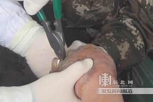 正在拆除戒指。