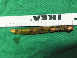 插入男子腦內(nèi)的樹枝。