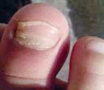 一幼兒園兒童“指甲異?！? title=